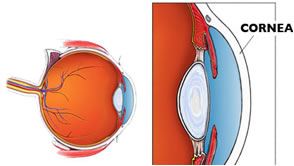 Ceratocone, ectasia, ectasia corneal, ectasia corneana, tratamento para ceratocone, cura para ceratocone, ceratocone avançado, ceratocone inicial, suspeita de ceratocone, lente para ceratocone, especialista em ceratocone, especialista ceratocone porto alegre, clinica especializada em ceratocone, oftalmologista ceratocone, oftalmologista para ceratocone, especializado em ceratocone, cone, córnea fina, cornea fina, córnea em forma de cone, cornea em forma de cone, ceratocone tratamento, ceratocone cirurgia, crosslink, cross link, crosslinking, cross linking, anel de ferrara, transplante de córnea, transplante de cornea